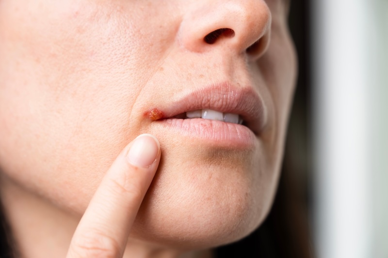 Lippenherpes behandeln mit Hausmitteln